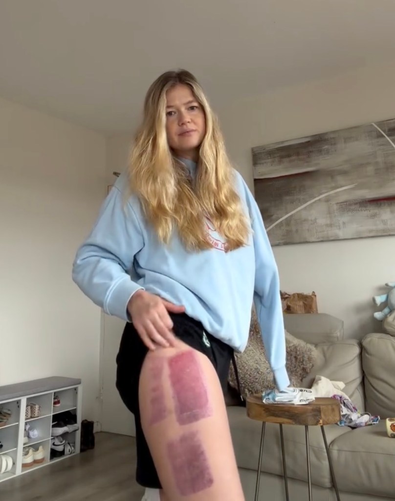 The mother of one, who lost an arm while swimming close to shore and between the flags at the popular beach on June 13, revealed her skin graft has failed.
